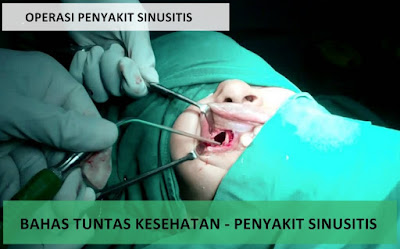 Obat Sinusitis Resep Dokter Yang Terbukti Ampuh