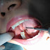 Chăm sóc sau nhổ răng khôn với chế độ phù hợp