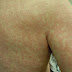 Morbilliform rash Pictures, Definition, Symptoms, Causes, Treatment