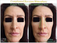 complicated revision rhinoplasty, female rhinoplasty, asymmetrical nostrils correction, complex rhinoplasty surgery, revision rhinoplasty specialist, open revision rhinoplasty, cartilage grafting in rhinoplasty, nasal valve collapse, nasal tip revision surgery, functional rhinoplasty, nasal airway obstruction, scar tissue rhinoplasty, septoplasty revision, auricular cartilage graft, costal cartilage graft, nostril asymmetry correction, refined nasal tip revision, natural rhinoplasty results, rhinoplasty aftercare tips, experienced rhinoplasty surgeon, facial aesthetic harmony, nasal reconstruction surgery, revision nose job, difficult rhinoplasty case, feminine nasal symmetry, secondary rhinoplasty procedure