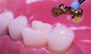 Trám răng có đau không ?