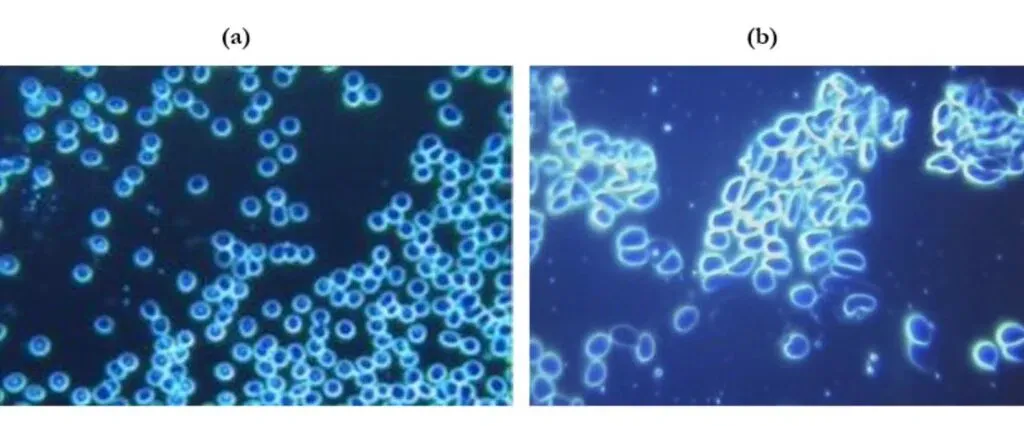 (a) The photo on the left at 40x magnification shows the blood condition of the patient before the inoculation. (b)The image on the right, also at 40x magnification, shows the deformation of the erythrocyte cell profile, and the strong tendency for the deformed erythrocytes to aggregate. (Source: IJTPVR)