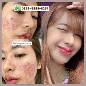 Hasil Pemakaian Tabita Skin Care