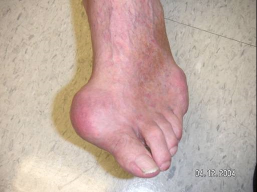 gout+Toe+Joint+with+Acute+Gout.jpg