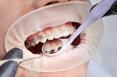 final treatment braces