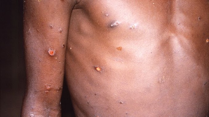 Monkeypox continua a se espalhar globalmente enquanto a Bélgica introduz quarentena