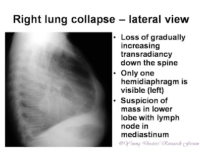 Loss of gradually increasing transradiancy down the spine Only one hemidiaphragm is visible (left) Suspicion of mass in lower lobe with lymph node in mediastinum