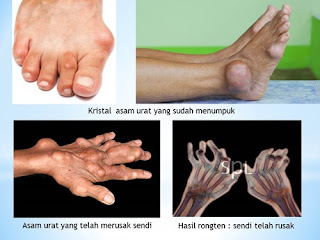 Obat Asam Urat Bengkak Kaki, Asam Urat Di Telapak Kaki, Bahaya Asam Urat Bagi Ginjal, Asam Urat Sayur Pantangan, Cara Penyembuhan Tradisional Asam Urat, Obat Sakit Asam Urat Secara Alami, Cara Penyembuhan Penyakit Asam Urat, Asam Urat Obatnya, Asam Urat Dan Kolesterol Normal, Obat Penderita Asam Urat Akut, Asam Urat Normal Puasa, Obat Asam Urat Bawang Putih, Penyakit Asam Urat Dan Pantangan, Analisis Asam Urat Dalam Darah, Jengkol Pantangan Asam Urat, Obat Asam Urat Dan Kolesterol Herbal, Cara Alami Untuk Menghilangkan Asam Urat, Tanaman Yang Dapat Menyembuhkan Penyakit Asam Urat, Asam Urat Bolehkan Makan Nangka, Efek Penyakit Asam Urat, Kaitan Asam Urat Dengan Ginjal, Ramuan Asam Urat Herbal, Obat Herbal Alami Asam Urat Tinggi, Asam Urat Jus Nanas, Asam Urat Pada Pinggang, Cara Mengobati Asam Urat Dengan Cepat Dan Alami, Ikan Yang Aman Untuk Penderita Asam Urat Dan Kolesterol, Makanan Yang Aman Untuk Asam Urat Dan Kolesterol, Air Kelapa Muda Bagi Asam Urat, Obat Menurunkan Asam Urat Dan Kolesterol, Pantangan Asam Urat Dan Pengobatannya, Ciri2 Asam Urat Dan Penyebabnya, Berapakah Asam Urat Yang Normal, Gejala Asam Urat Pada Lutut, Penyakit Asam Urat Kandas Berkat Herbal, Cara Mengobati Penyakit Asam Urat Alami, Obat Menghilangkan Penyakit Asam Urat, Gimana Cara Mengatasi Asam Urat, Asam Urat Etiologi, Cara Buat Obat Alami Asam Urat, Harga Alat Cek Asam Urat Nesco, Penyebab Asam Urat Dan Apa Obatnya, Gejala Kolesterol Dan Asam Urat, Angka Normal Asam Urat Untuk Wanita, Obat Tradisional Untuk Menyembuhkan Sakit Asam Urat 