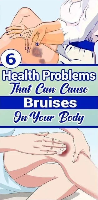 6 Health Problems That Can Cause Bruises On Your Body
