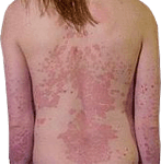 psoriasis