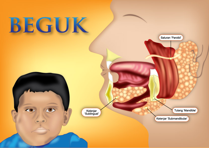 BENGKAK TUGUNG (GONDONG) BEGUK ~ perubatan tradisional melayu