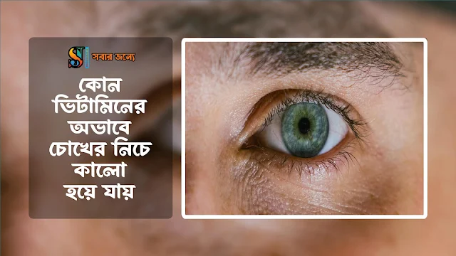 কোন ভিটামিনের অভাবে চোখের নিচে কালো দাগ হয়
