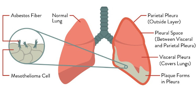 Mesothelioma A Cancer of The Lung Lining