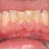 Răng ố vàng là bị bệnh gì?