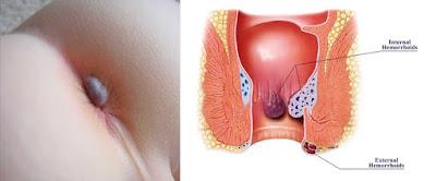 Obat Benjolan di Anus Tradisional Yang Alami dan Mujarab