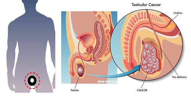 http://akardaun2015.blogspot.com/2015/11/baca-sebelum-terlambat-5-gejala-kanker.html