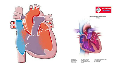 What is Atrioventricular Canal Defect ?