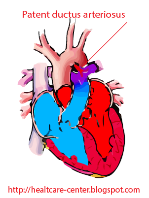 Patent ductus arteriosus