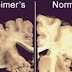 [Artikel]Sistem Koordinasi; Penyakit Alzheimer: Penyebab, Diagnosa, Pencegahan, dan Penanganan