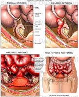 Nursing Diagnosis Deficient Fluid Volume