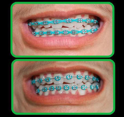 Warna Bracket Behel Yang Populer!