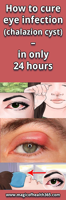 HOW TO CURE EYE INFECTION (CHALAZION CYST) – IN ONLY 24 HOURS