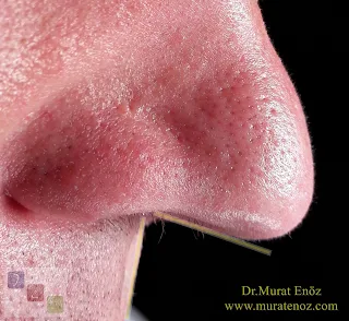 Drooping Nose Tip Surgery - Nose Tip Plasty in Istanbul - Nasal Tip Plasty in İstanbul - Nose Tip Reshaping in İstanbul - Nose Tip Surgery in İstanbul - Nose Tip Lifting in İstanbul - Droopy Nasal Tip Rhinoplasty - Droopy Nasal Tip Correction - Droopy Nasal Tip Surgery - Nasal Tip Ptosis - Droopy Tip Correction - Nose Tip Surgery Turkey