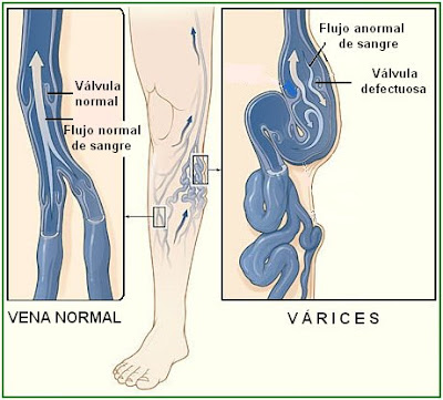 vena varicosa