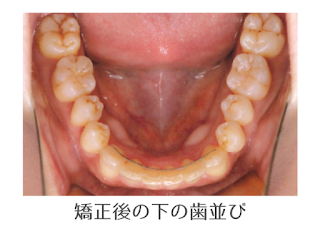 矯正の写真　©親知らずの矯正ブログ