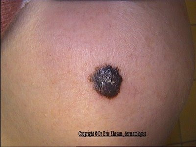 Clinically a melanoma was