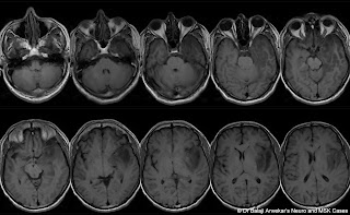 CORTICAL%2BVEIN%2BTHROMBOSIS%2BMIDDLE%2B