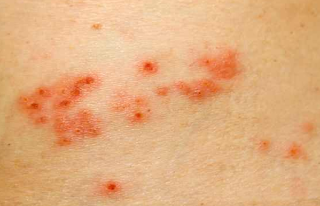All About Herpes Zoster, Causes, Symptoms, Prevention and treatment