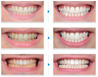 Tẩy trắng răng đơn giản an toàn với Brite Smile