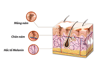 Sẽ ra sao nếu điều trị nám không đúng cách ?