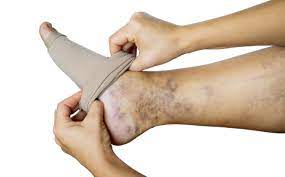 Understanding Varicose Veins: Causes, Symptoms, and Treatment Options