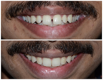 Clear Aligner dental treatment at Jamnagar