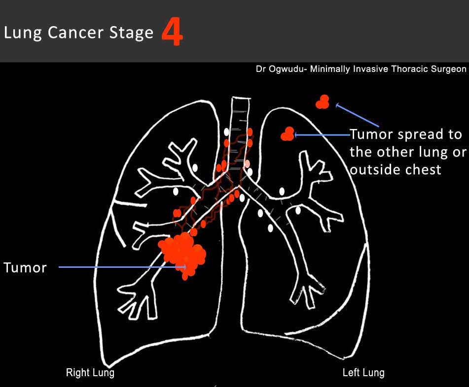 Lung Cancer: Lung Cancer Life Expectancy