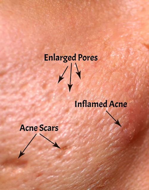 WHAT ARE OPEN PORES? TYPES, CAUSES, WHAT DIFFERENCE BETWEEN OPEN PORE AND CLOGGED PORES? HOW CAN YOU TELL IF YOU HAVE OPEN PORES, TREATMENT