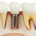 Trồng răng implant bao lâu thì ăn nhai bình thường