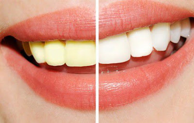 Công nghệ tẩy trắng răng Laser Whitening là gì?