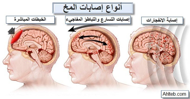 أنواع إصابات الرأس التي تسبب ارتجاج المخ