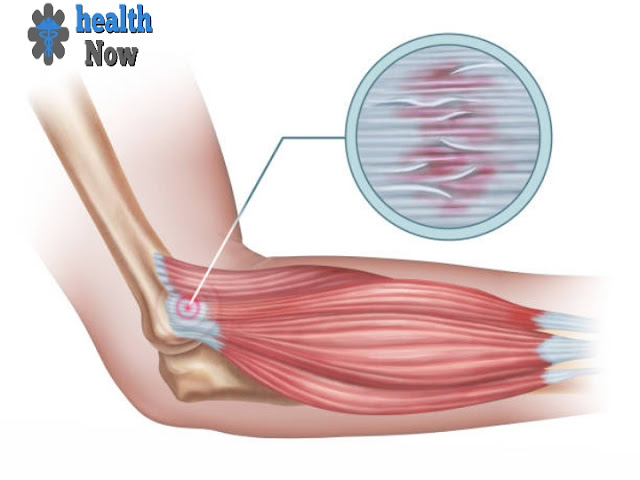 Torn elbow ligament causes and diagnosis.  Its treatment and risks.