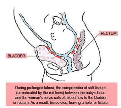 FISTULA POST PARTO