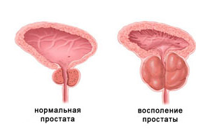 Простатит, аденома простаты. Народные рецепты лечения Простатит, аденома простаты. Народные рецепты лечения