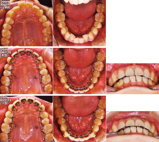 歯列矯正：定期検診その12
