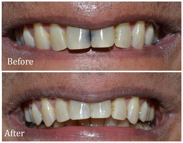 Front Teeth Decay treated with Composite filling at Jamnagar