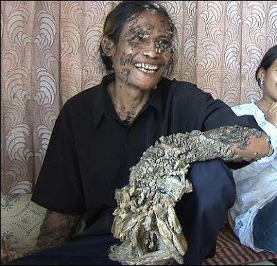 Human Pappiloma Virus Dede Koswara Tree Man