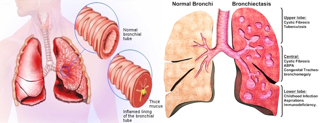 Pengobatan Herbal Bronkiektasis