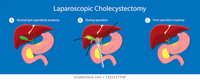 Gallbladder Cancer: Causes, Symptoms, and Treatment