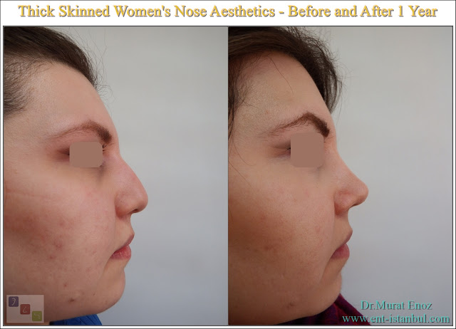 thick skinned nose job,Rhinoplasty for oily round nose,Ethnic nose aesthetic,Before and 1 year after female rhinoplasty,